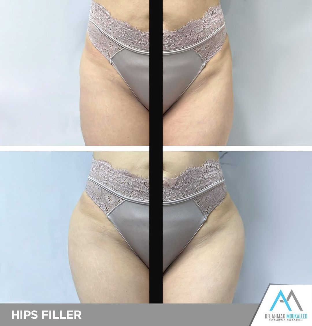 Hip Dips – Dr. Ahmad Moukalled